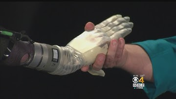Company Debuts New Arm Prosthesis That Moves With Muscle Signals