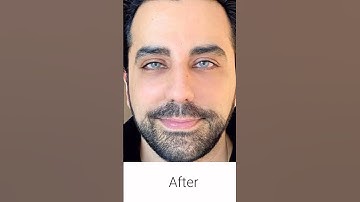 Change the Color of Your Eyes www.MyColorEyes.com #keratopigmentation #coloreyes #shorts