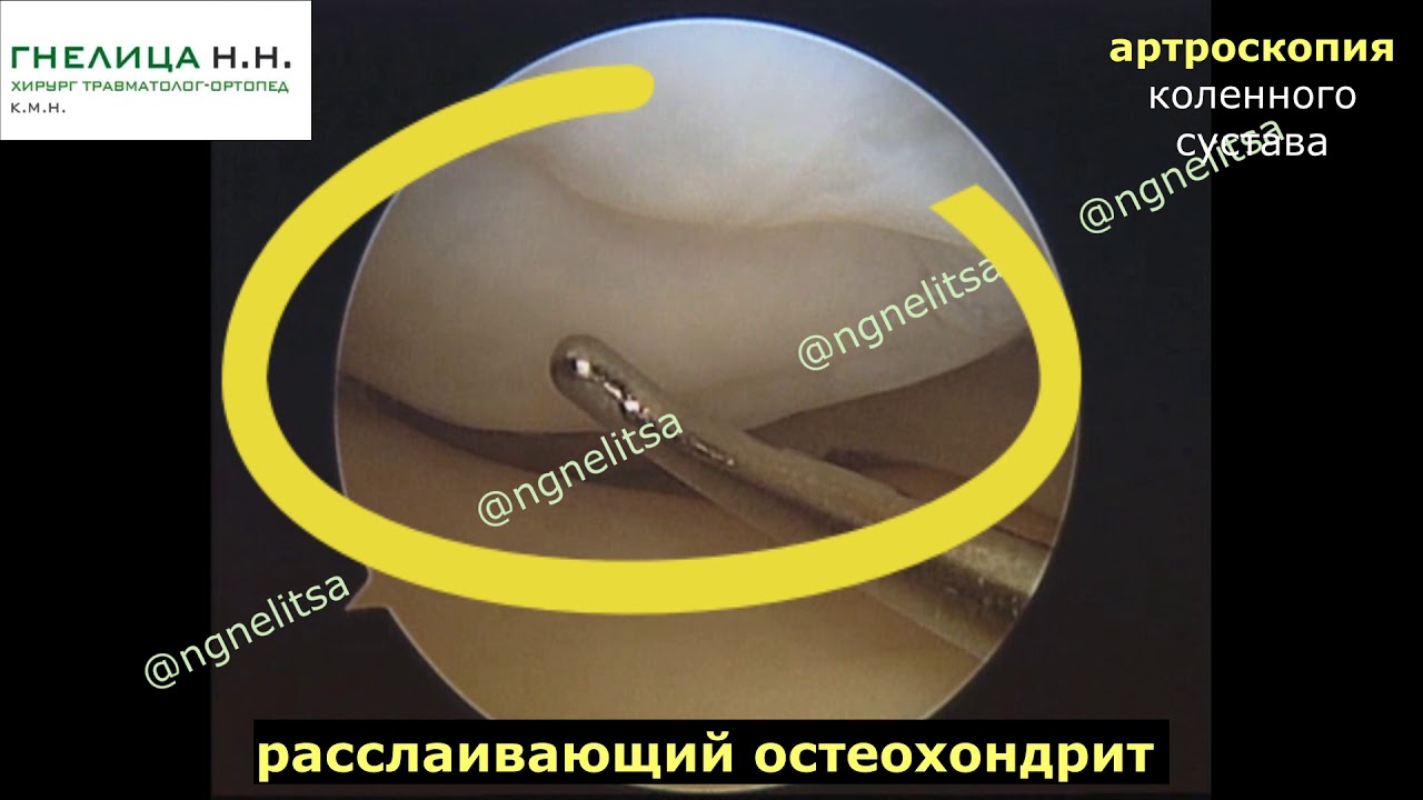 Болезнь Кенига, остеохондрит - оперативное лечение (архив, 2008 года ...