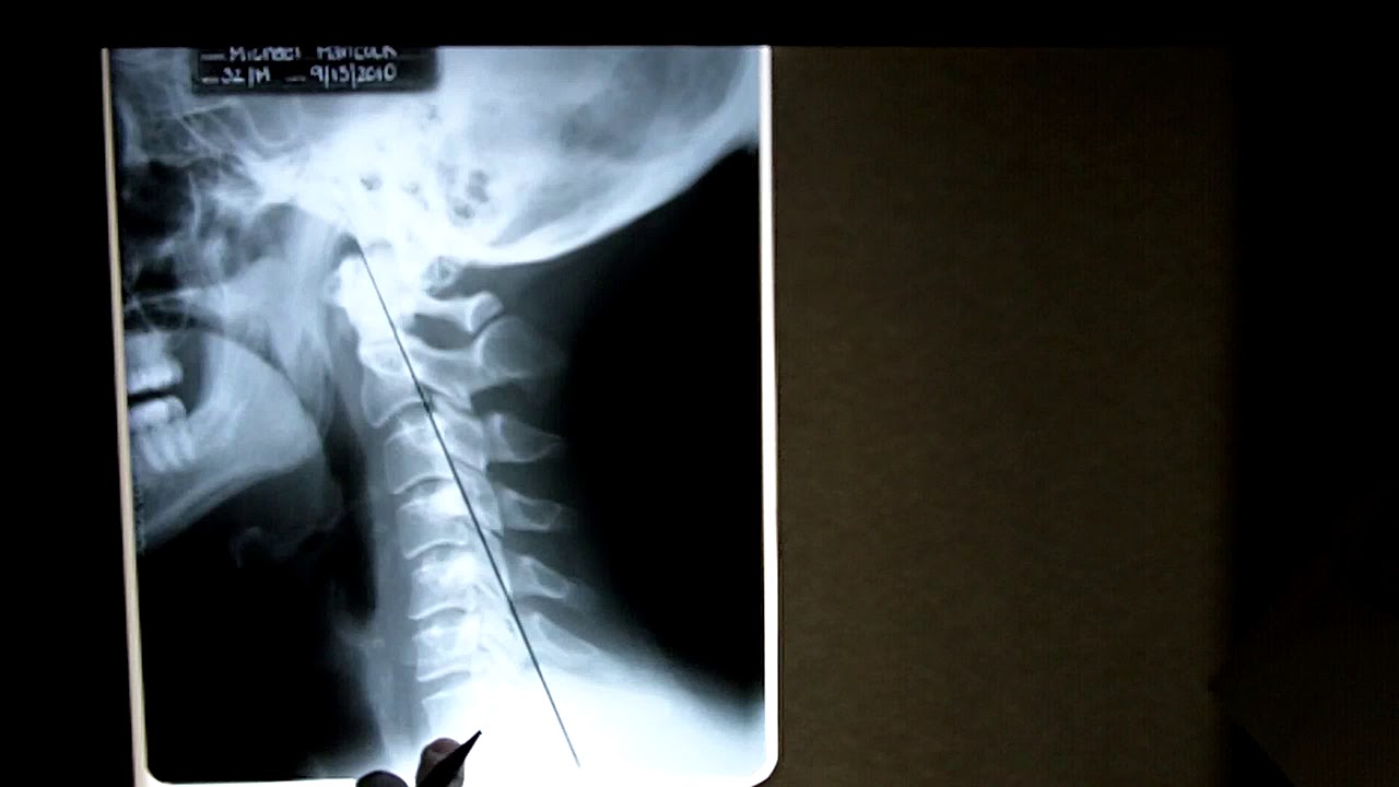 cervical x-ray analysis 1 upload image