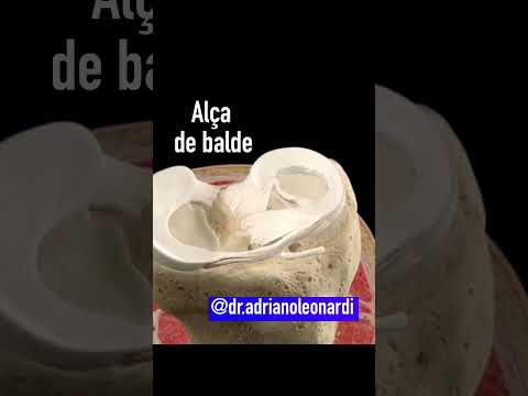 Vídeo: Uma lágrima de menisco apareceria em um raio-x?