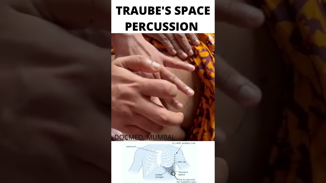 TRAUBE'S SPACE PERCUSSION FOR SPLEENOMEGALY