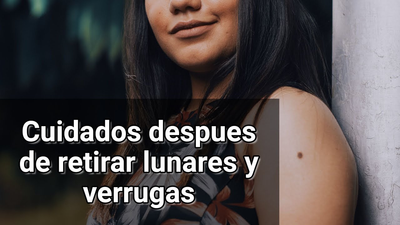 ¿Que cuidados se deben tener después de retirar lunares