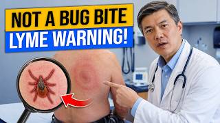 That “Bug Bite” Rash May Be Lyme Disease — Especially After 60