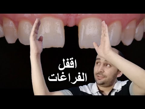 علاج الفراغات بين الاسنان الامامية | سد الفراغات بين الاسنان