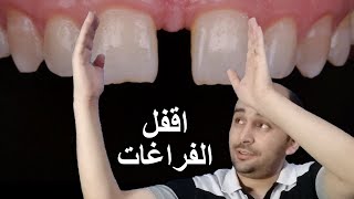علاج الفراغات بين الاسنان الامامية | سد الفراغات بين الاسنان