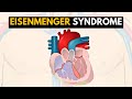 Eisenmenger Syndrome Explained: A Comprehensive Guide