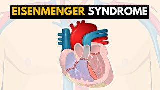 Eisenmenger Syndrome Explained: A Comprehensive Guide