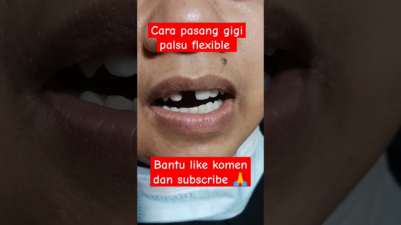 cara pasang gigi palsu flexible 