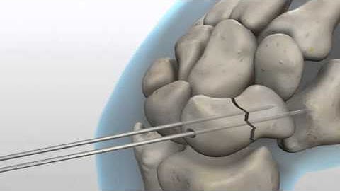 Acutrak 2 0 screw for a Scaphoid Hand Fracture