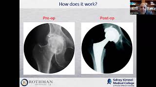 Rothman Webinar - Hip & Knee Replacement and Getting Home Fast with Dr. Arjun Saxena