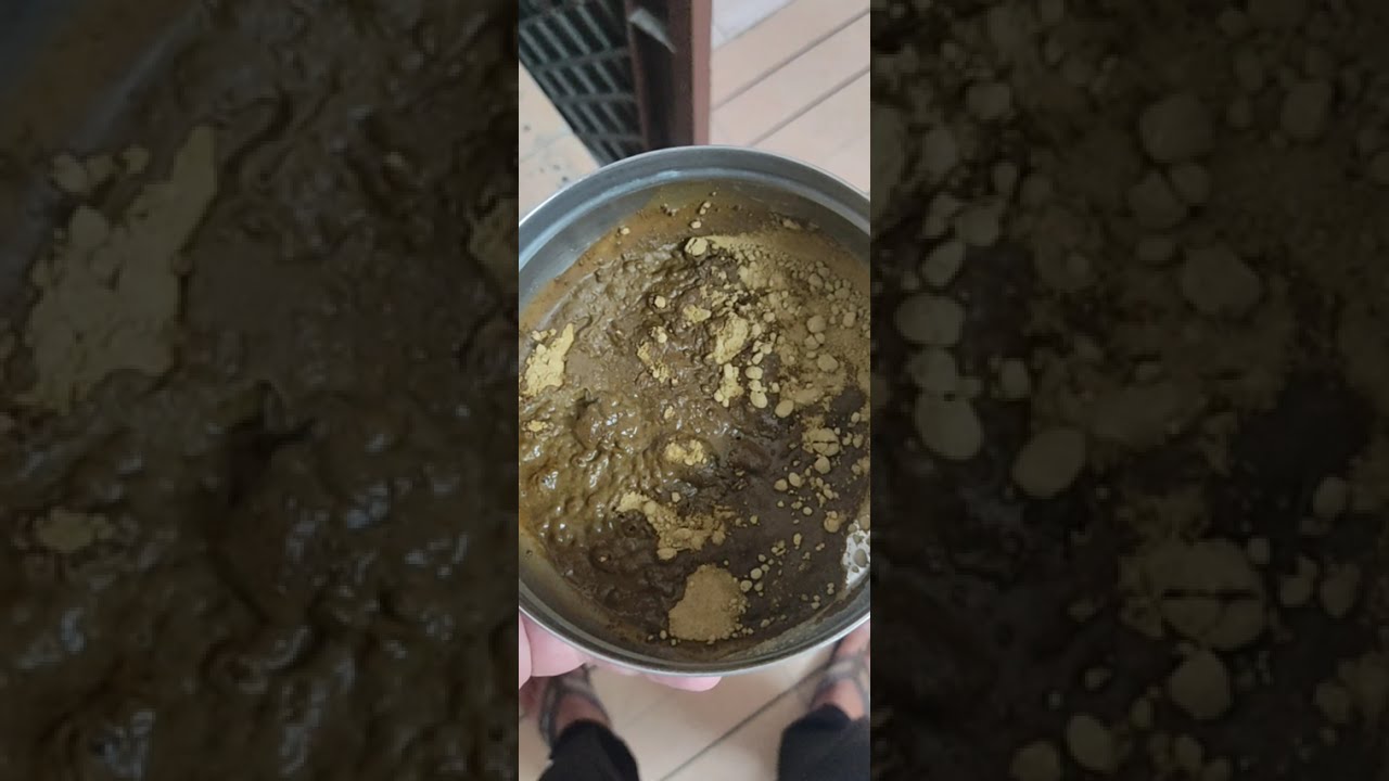 Seborrheic Dermatitis 8 Years! Finally Got Relief? 😱 Scalp Flakes & Treatment Explained