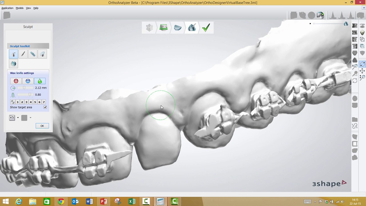 3Shape Ortho Analyzer How to Debond a Model YouTube
