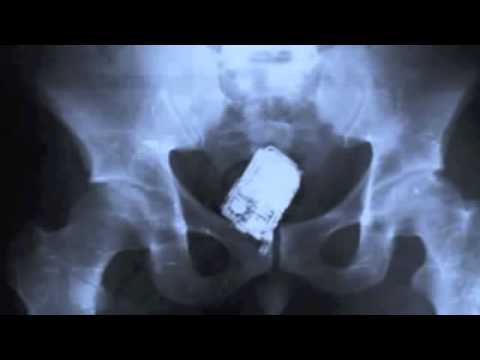 25 Strangest Things Found In X Ray - YouTube