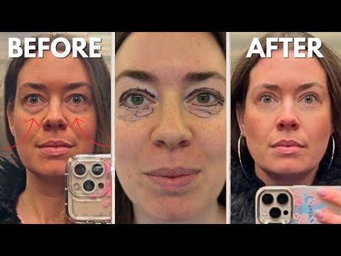 The result of my eyelid correction ABOVE & BELOW 👁️ // 1 year later | ♥ iamtheknees