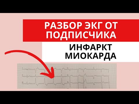 Инфаркт миокарда. Разбор ЭКГ от подписчика. Острый коронарный синдром с подъемом сегмента ST