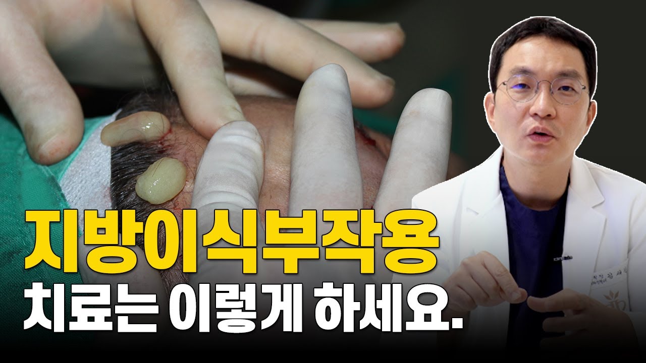 지방이식부작용 해결할 수 있습니다! 치료는 반드시 이렇게 하세요.