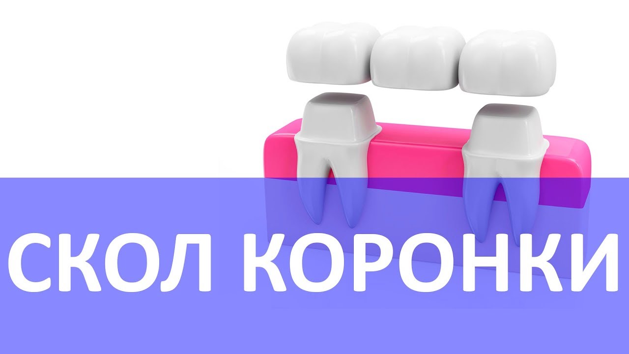 Скол коронок - как этого не допустить | Миография | T-SCAN