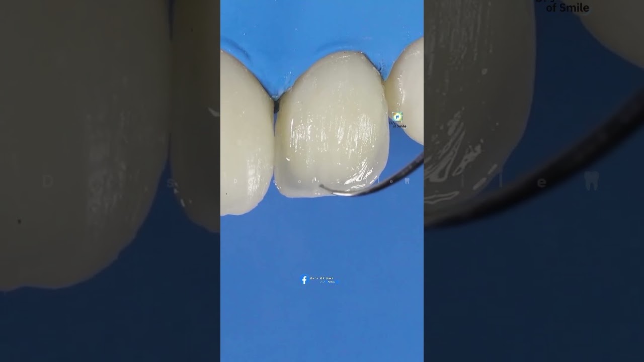 𝙋𝙚𝙜 𝙇𝙖𝙩𝙚𝙧𝙖𝙡 𝙄𝙣𝙘𝙞𝙨𝙤𝙧𝙨 𝘿𝙞𝙧𝙚𝙘𝙩 𝙇𝙖𝙮𝙚𝙧𝙞𝙣𝙜 𝘾𝙤𝙢𝙥𝙤𝙨𝙞𝙩𝙚 𝙍𝙚𝙨𝙩𝙤𝙧𝙖𝙩𝙞𝙤𝙣 𝙨𝙩𝙚𝙥 𝙗𝙮 𝙨𝙩𝙚𝙥 𝙥𝙧𝙤𝙘𝙚𝙙𝙪𝙧𝙚 #viralshorts