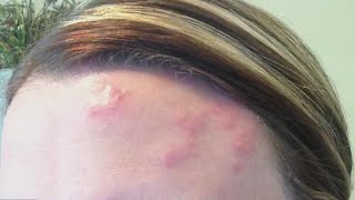 Who should get vaccinated against shingles | FOX 5 News