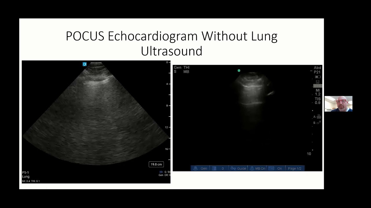 Webinar: Point of Care Echocardiography in Critical Care