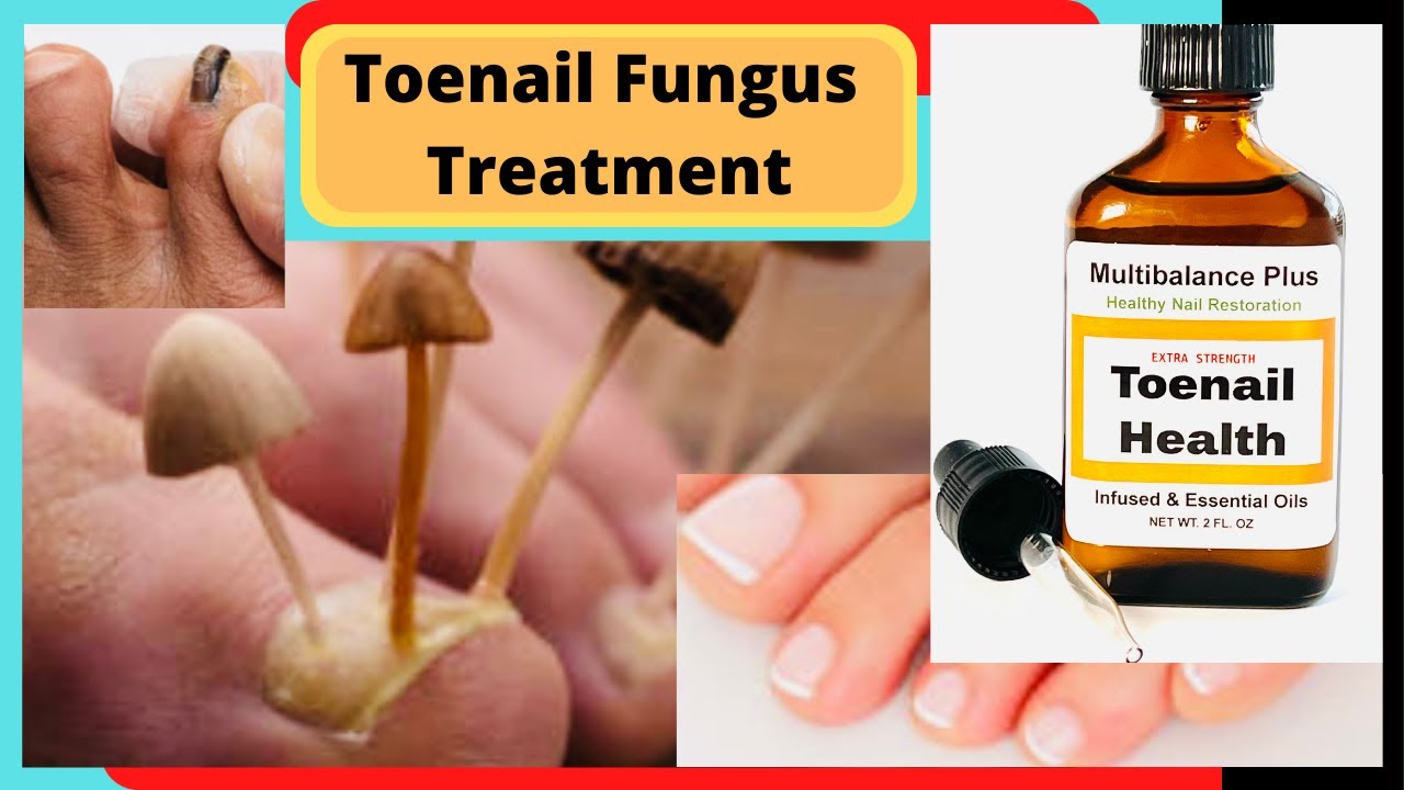 Natural Tonail Fungus Cure and Athlete's Foot Cure Natural Fungus