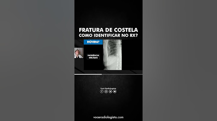 Como identificar uma fratura de costela no RX? ⚡