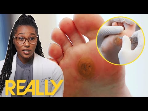 Dr. Ebonie Helps Woman With Severe Case Of Foot Callus | My Feet Are Killing Me