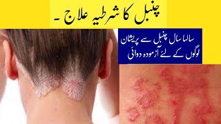 Chambal ka ilaj | Psoriasis  Treatment | Magical cream to cure skin