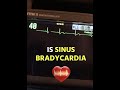 Sinus Bradycardia For EMS