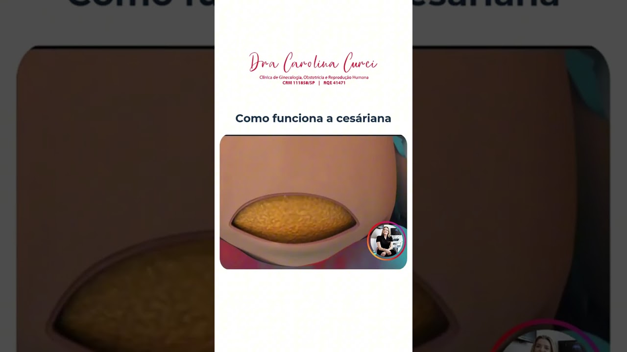 🤰 Como Funciona a Cesariana?