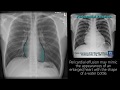 Radiograph tutorial chest xray  cxr  radiology nation