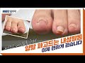 (Eng)양발 모두 내성발톱 깔끔하게 펴버리기! (ft. 스케일링) l Fungal/Ingrown toenails [NP케어]