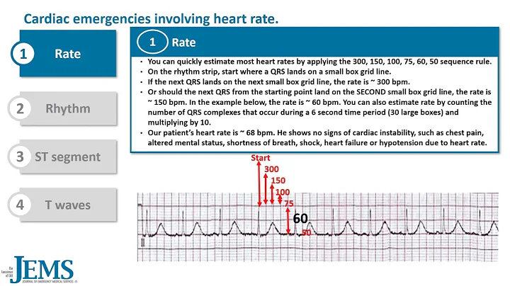 ECG 5 Minute Consult de Winter T wave FINAL 10 14 23