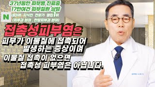 4K)접촉성 피부염은 이 물질에 접촉되어 발생하는 증상이며 , 물집 접촉이 없으면 일반적인 피부염입니다.