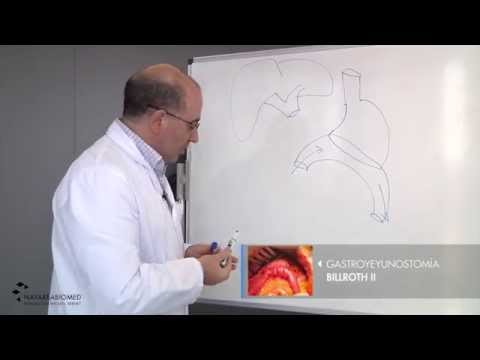 Vídeo: Ensayo Controlado Aleatorio Prospectivo Que Compara La Eficacia Y La Seguridad Del Bypass Gástrico Roux-en-Y Y El Bypass Gástrico De Una Anastomosis (el Ensayo RYSA): Protocolo De