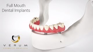 Coventry Dental Implants Dentist Shows Best Same Day Full Whole Mouth Dental Teeth Implants Verum UK