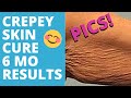 HOW TO FIX CREPEY SKIN NATURALLY