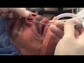 Latera Implant insertion in OR