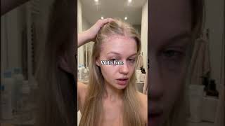 Break up glow #psoriasis #scalppsoriasis #hairtok #dandruff #skincare #scalpcare #viral #haircare