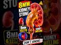 8mm Kidney Stone #kidneyhealth #swelling #kidneystone #navimumbai #doctor