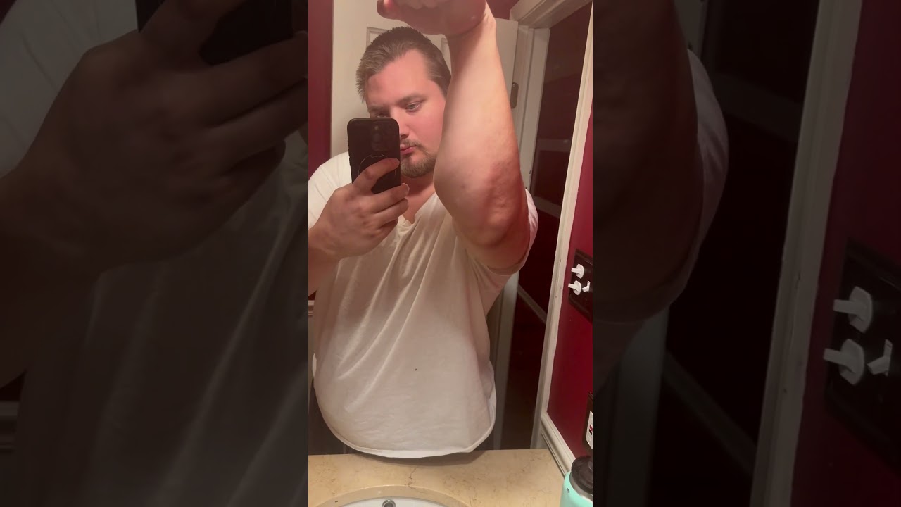 Myostatin deficiency