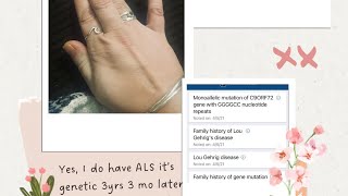 My ALS Story Quick Update Yes, I have ALS