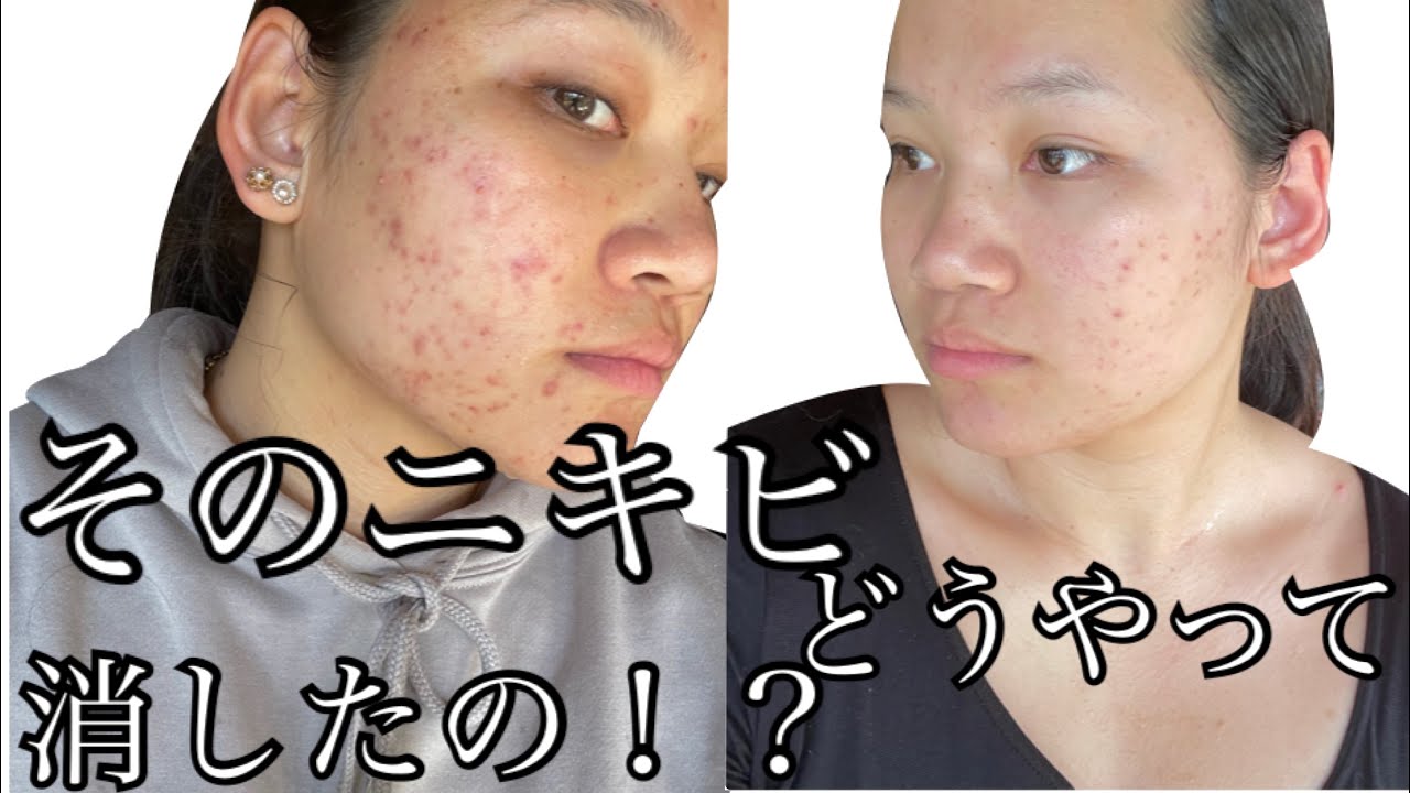 皮膚科でも治らなかったニキビが まさかの 治った Youtube