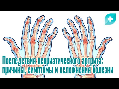 Последствия псориатического артрита: причины, симптомы и осложнения болезни