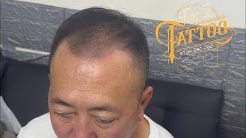 Xăm Chân Tóc Cho Anh Trai Bị Rụng Tóc