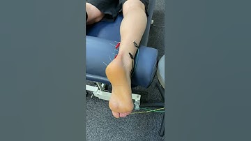 Dry Needling Achilles Tendinopathy