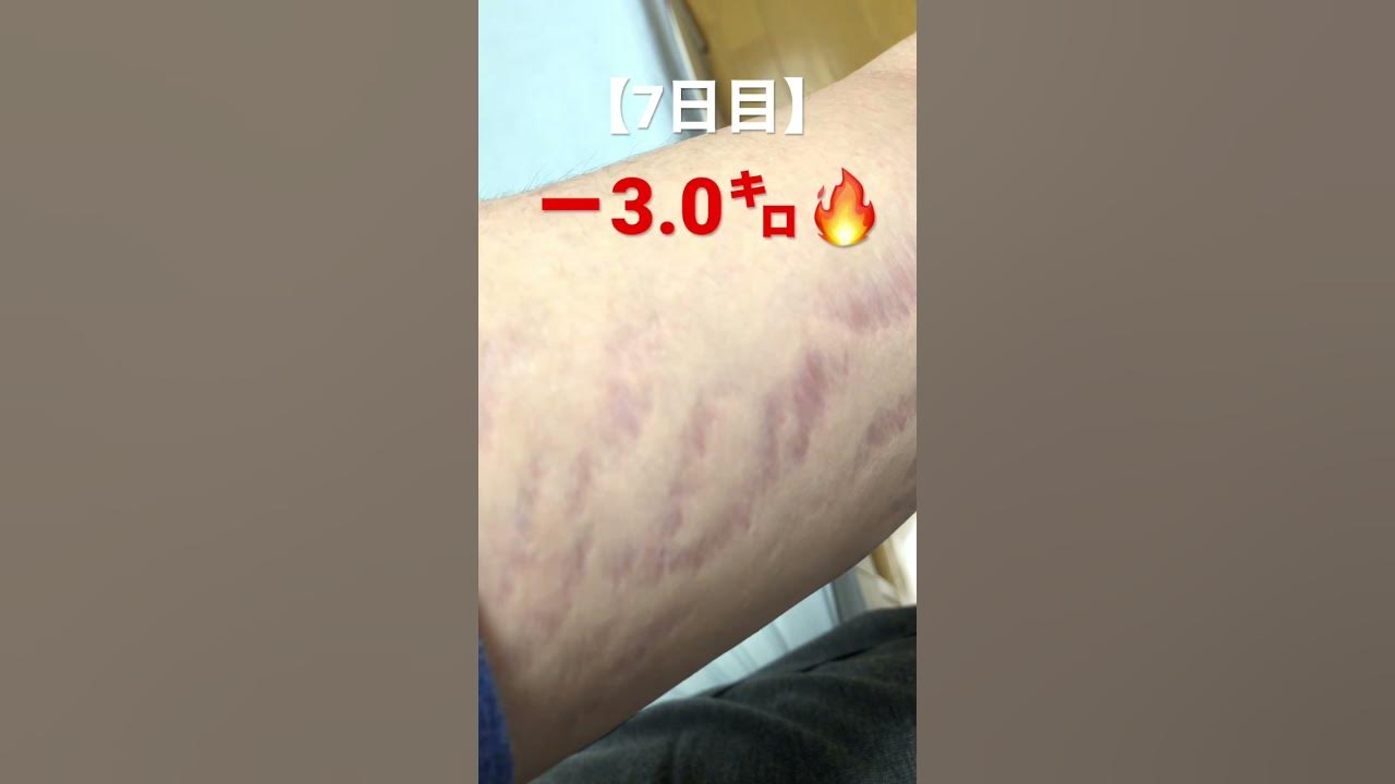 【ダイエット7日目】 肉割れって痩せれば消える?検証 YouTube 【ダイエット7日目】 肉割れって痩せれば消える?検証 YouTube