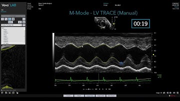 Auto LV vs LV Trace: M-Mode