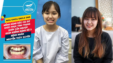 BN Thùy Duyên - Niềng răng mắc cài sứ khắc phục tình trạng khớp cắn ngược